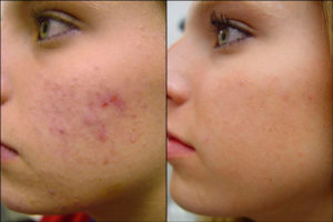 acne skin