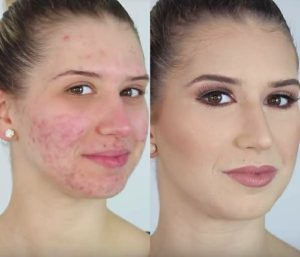 acne treatment